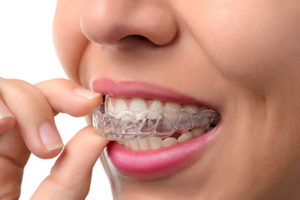 woman with invisalign, dental braces tx