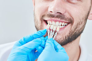 man showing teeth with whitening chart, dental veneers tx