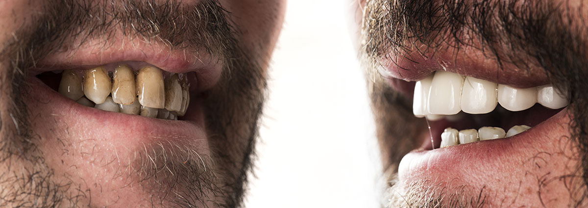 how to prevent tooth decay