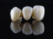 examples of how long do dental bridges last