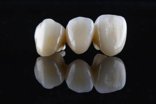 how long do dental bridges last examples of how long do dental bridges last