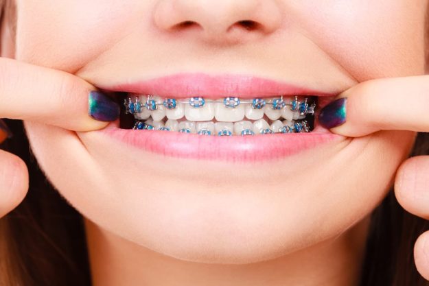 individual showing braces after learning about braces