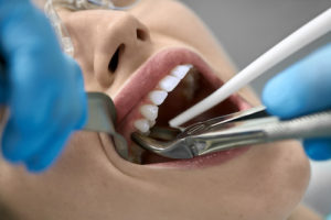 woman getting a tooth extraction