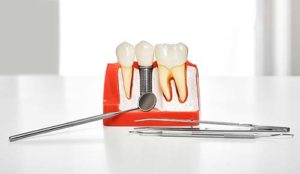 model of dental implants