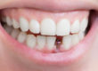 example of a single tooth implant