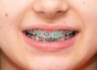 child with braces