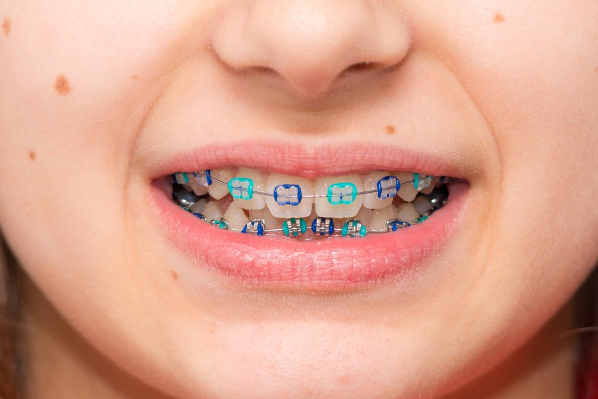 child with braces