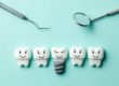 example of a dental implant