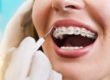 example of dental braces for adults