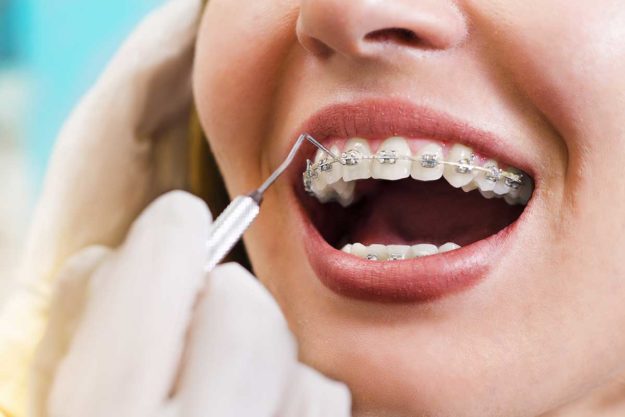5-Signs-You-Need-Dental-Braces-Again example of dental braces for adults