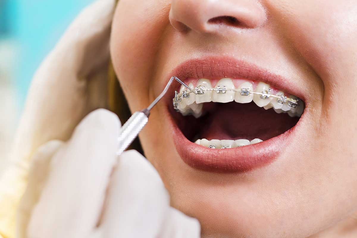 5 Signs You Need Dental Braces Again Orthodontics Texas 5 Signs You Need Dental Braces Again Orthodontics Texas